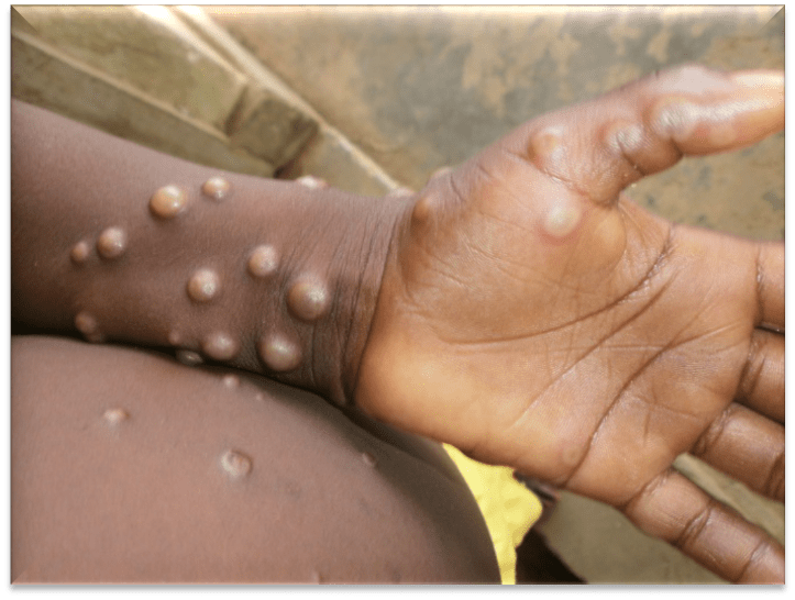 Mpox en Guinée : l’épidémie s’étend à 15 districts, l’ANSS tire la sonnette d’alarme